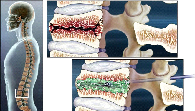 tratament conservator al coloanei vertebrale
