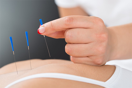 acupunctura