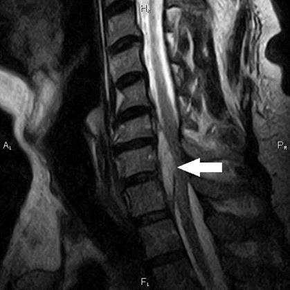 abcesul epidural