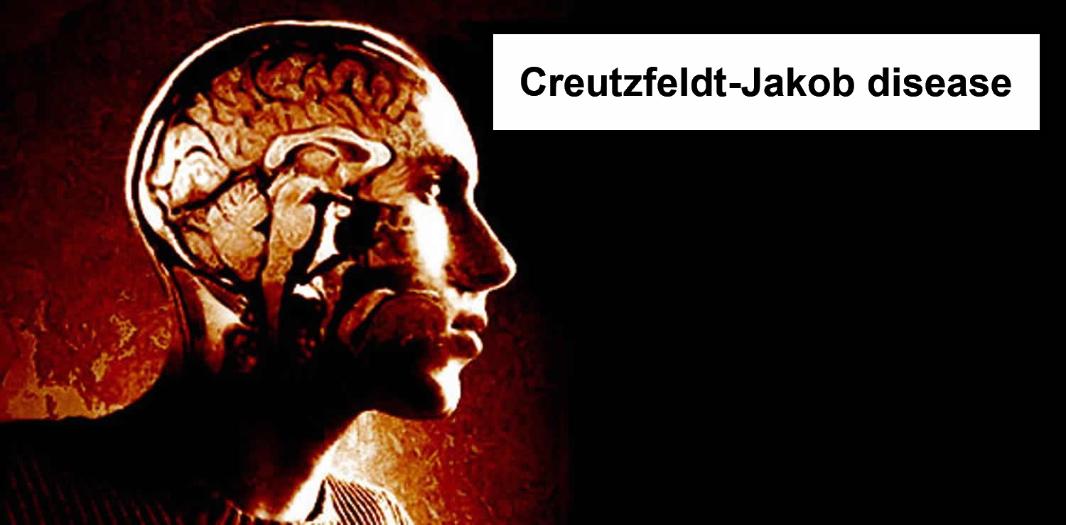creutzfeldt jakob