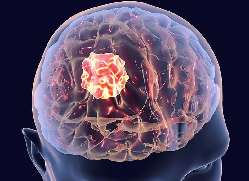 glioblastoma