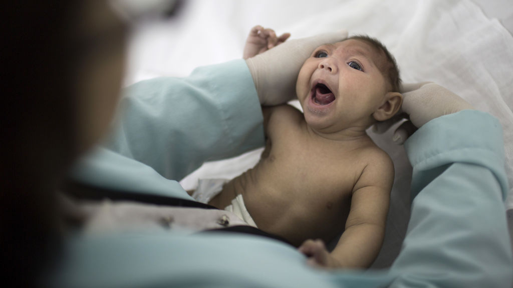 microcephaly