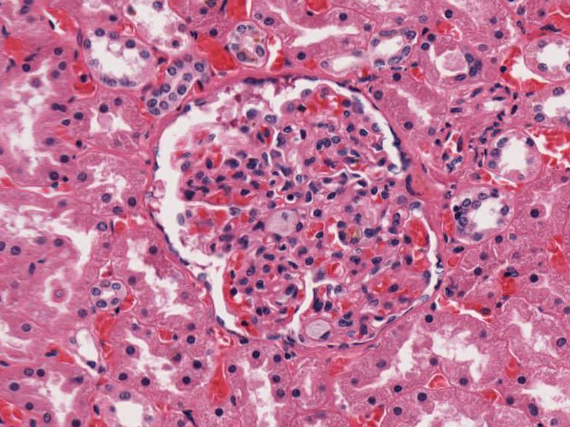 pick disease